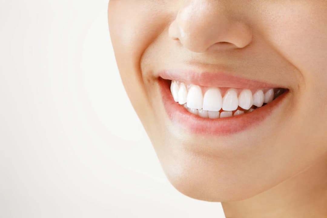 A bright, white smile after take-home teeth whitening