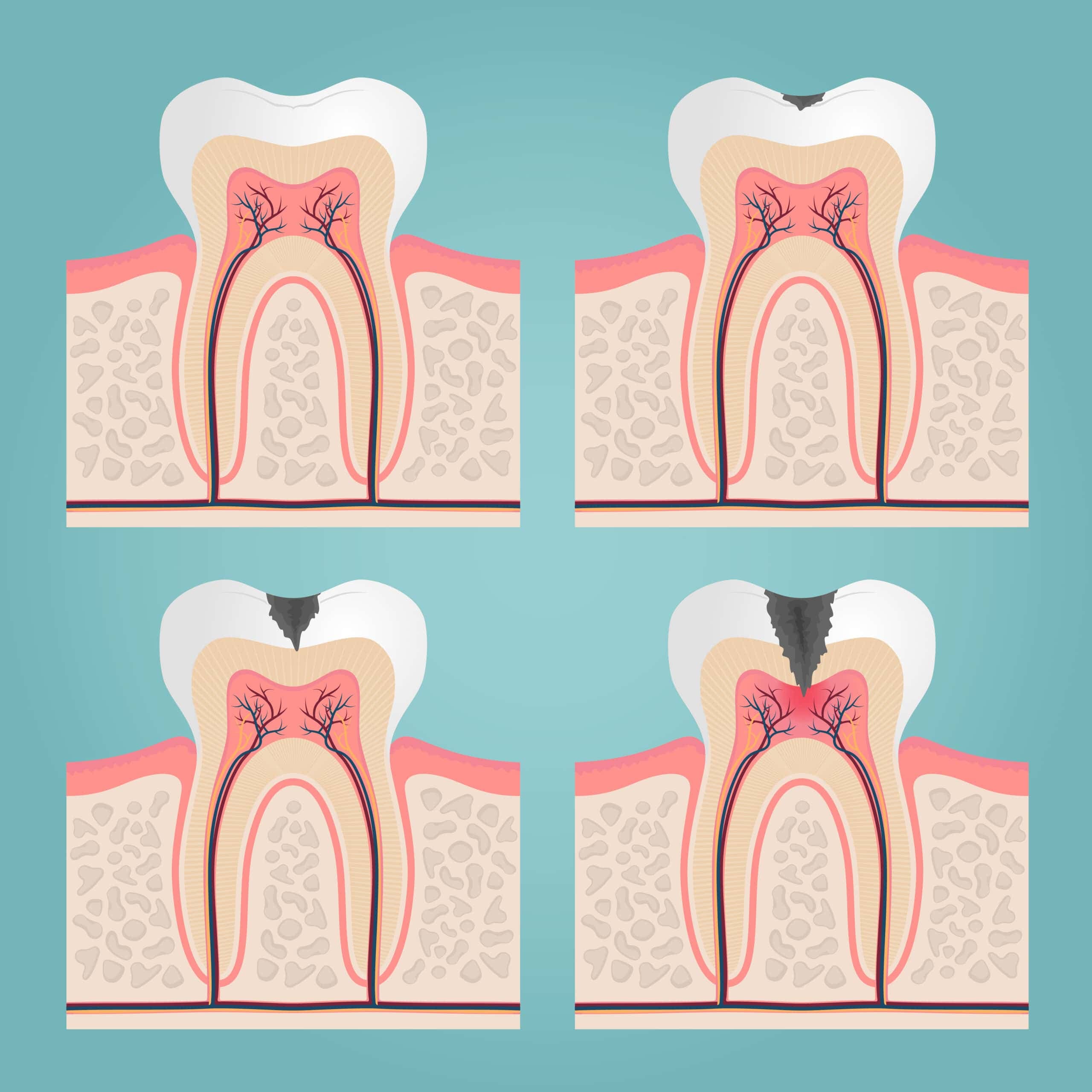 Tooth Decay